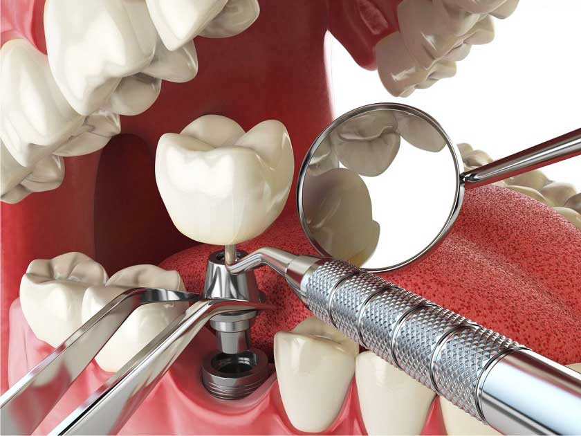 Trường hợp nào có thể tiến hành cấy ghép implant tức thì? Trường hợp nào có thể tiến hành cấy ghép implant tức thì?