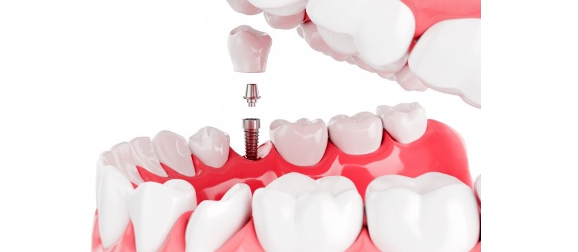 Ưu điểm của cấy ghép implant tức thì Ưu điểm của cấy ghép implant tức thì