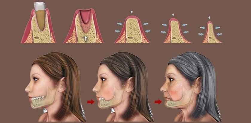 Mất răng lâu ngày có thể gây tiêu xương hàm