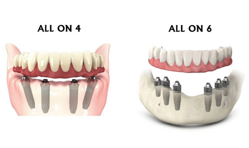Những lợi ích của Implant All on 4 – All on 6