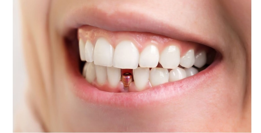 Khôi phục chức năng ăn nhai tự tin bằng cấy ghép implant