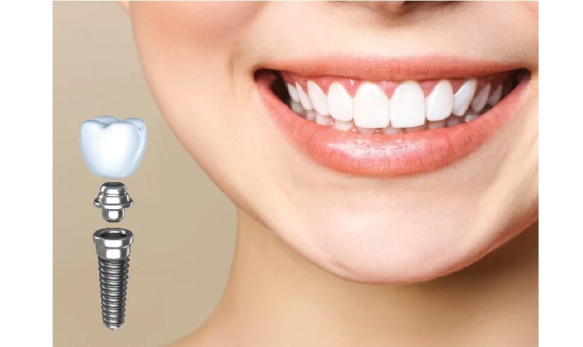 Cấy implant có nhiều ưu điểm vượt trội so với những phương pháp phục hình truyền thống