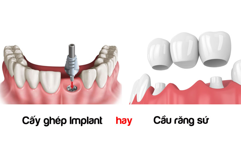 Nên trồng răng implant hay làm cầu răng sứ | Nha khoa Nhân Tâm