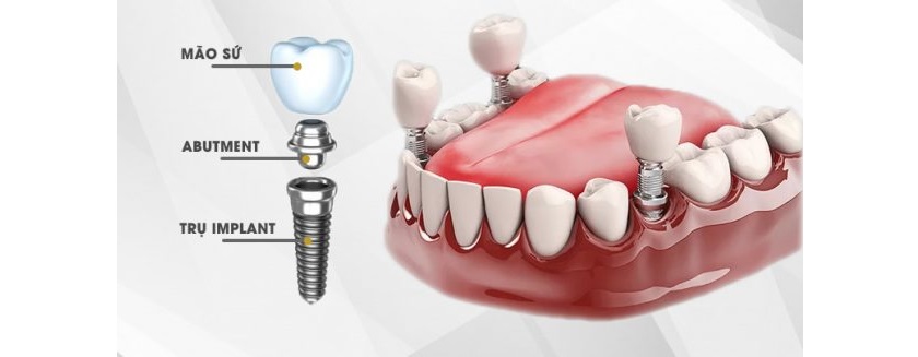 Cấy ghép implant với nhiều ưu điểm vượt trội