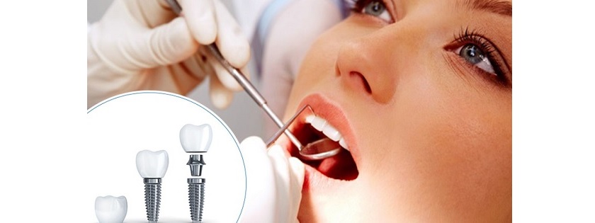 Trường hợp nào nên cấy ghép implant?