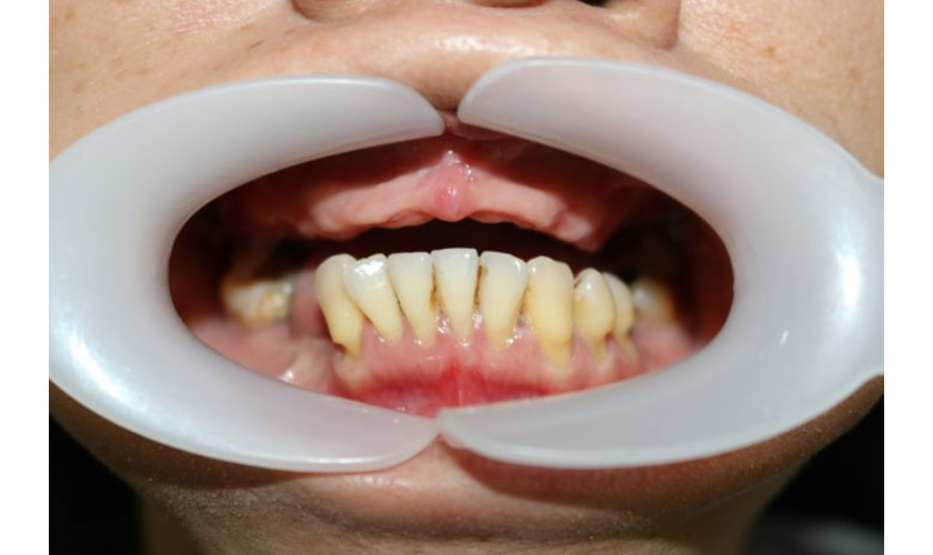 Giải pháp nào là tốt nhất cho trường hợp mất răng toàn hàm?