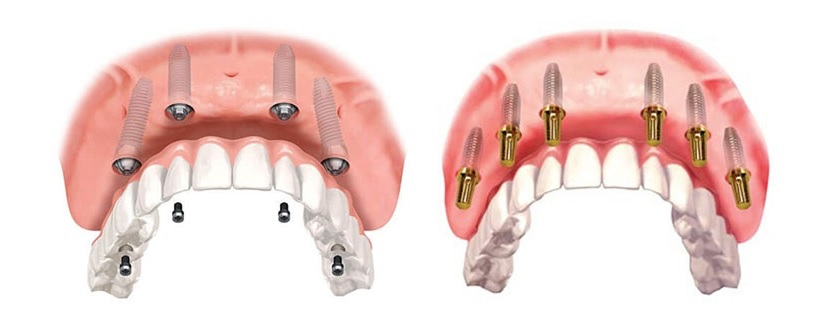 Phục hình toàn hàm All-on-4/All-on-6