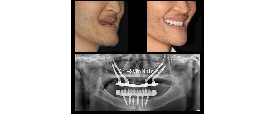 Có nhiều nguyên nhân dẫn đến tình trạng thiếu răng bẩm sinh Có nhiều nguyên nhân dẫn đến tình trạng thiếu răng bẩm sinh