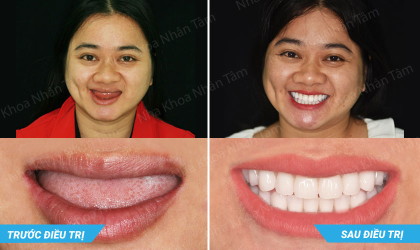 Cấy ghép implant thành công cho trường hợp mất răng toàn hàm bẩm sinh Cấy ghép implant thành công cho trường hợp mất răng toàn hàm bẩm sinh