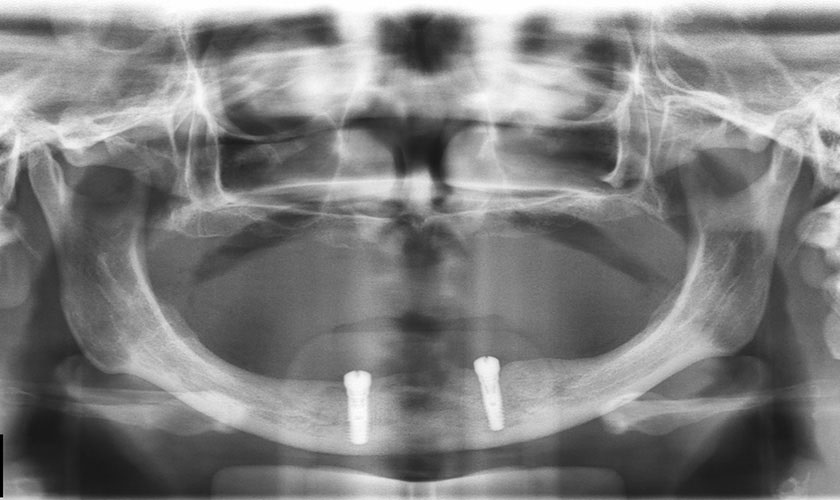Thiếu răng bẩm sinh gây ra tình trạng tiêu xương hàm