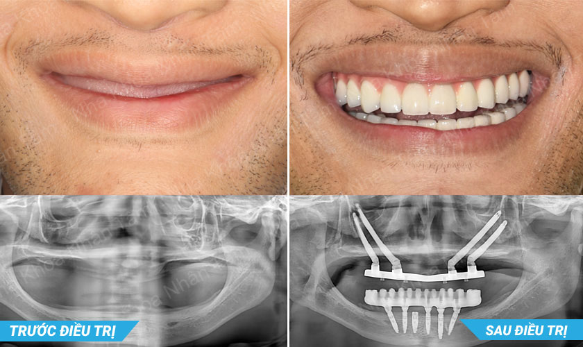 Implant xương gò má là giải pháp tối ưu cho bệnh nhân có xương hàm trên bị tiêu trầm trọng
