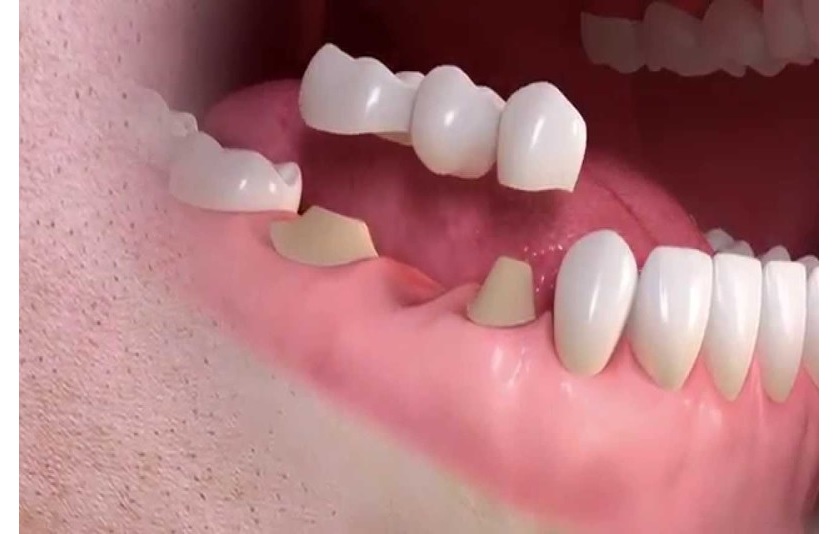 Phục hình cầu răng sứ Phục hình cầu răng sứ