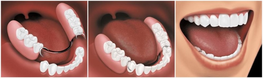 Răng giả tháo lắp Răng giả tháo lắp