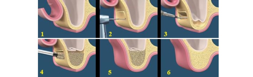 Nâng xoang trong cấy ghép răng implant