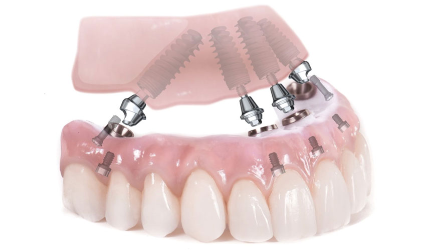 Implant All On 6 - Trồng răng implant giá bao nhiêu?