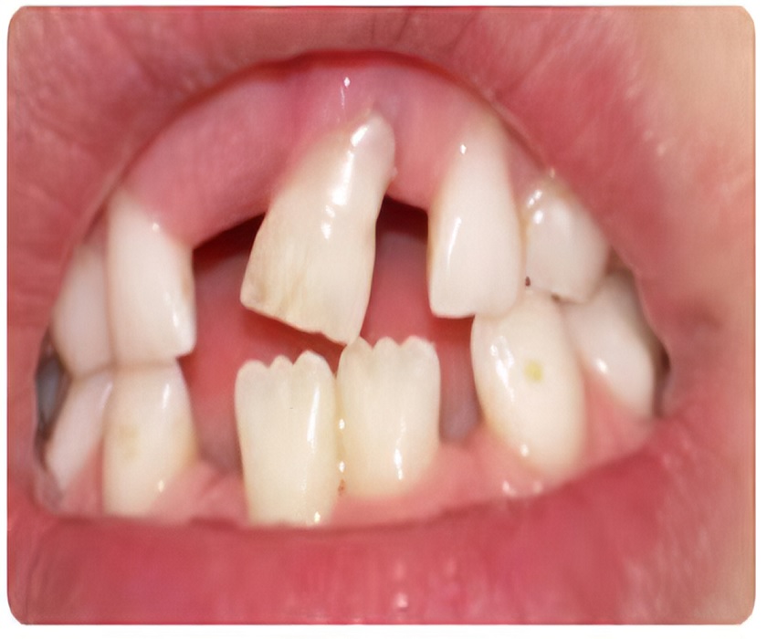 Mất răng lâu ngày sẽ gây ra những hậu quả không tốt cho răng miệng