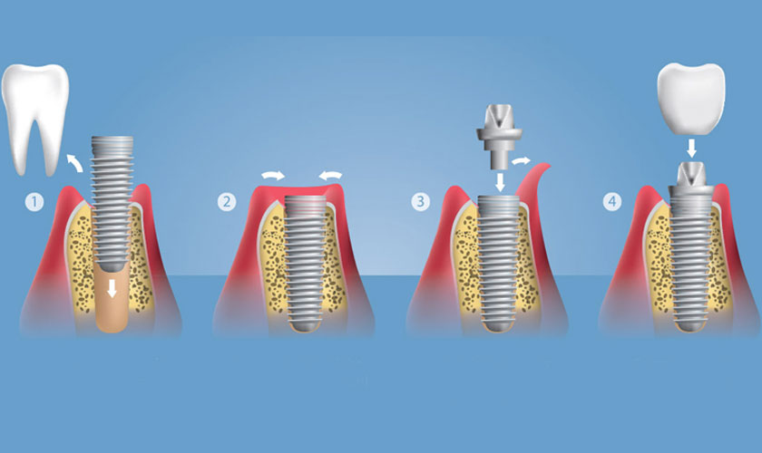 Quy trình trồng răng implant và những lưu ý thường gặp