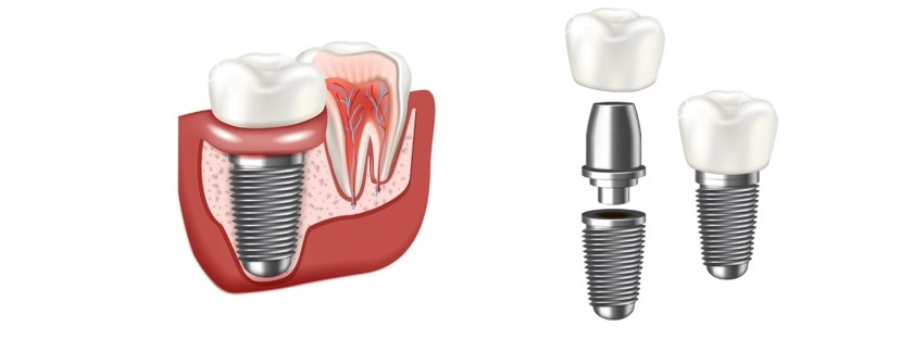 Quy trình trồng răng implant
