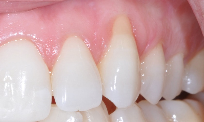 Trồng răng Implant giúp ngăn tình trạng tiêu xương, tụt nướu