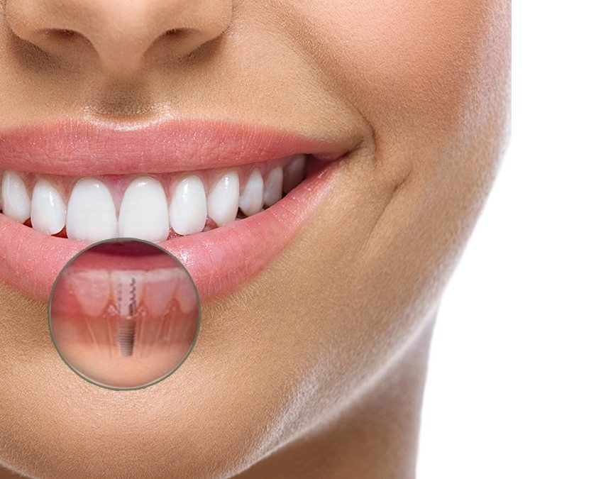 Răng Implant giúp mang lại vẻ đẹp tự nhiên cho hàm răng