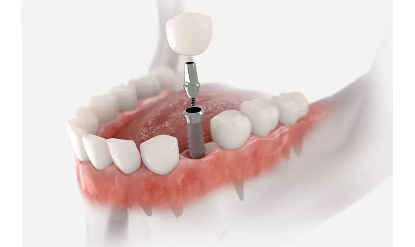 Cấy ghép răng Implant giá bao nhiêu? Có đắt không?