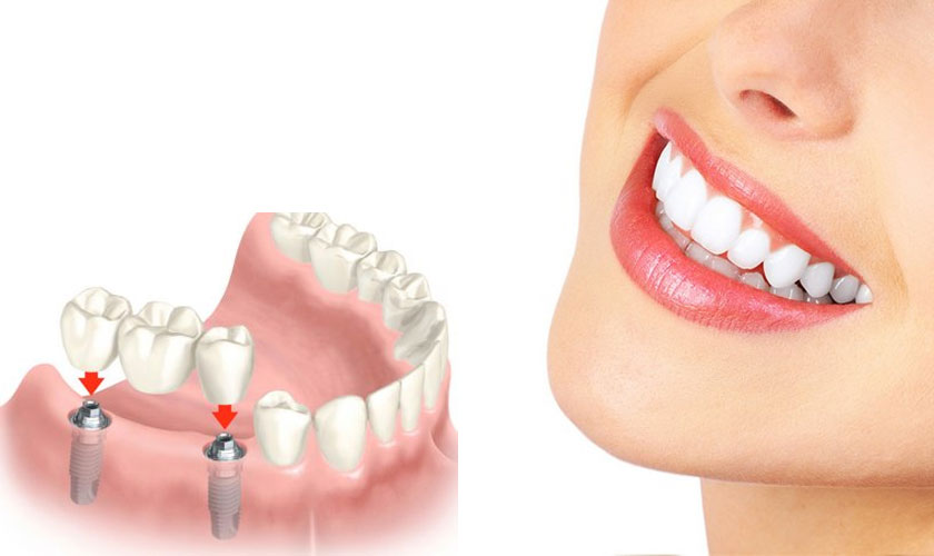 Một ca cấy ghép răng Implant mất bao nhiêu tiền?