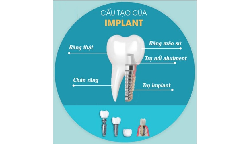 Cấu tạo răng Implant