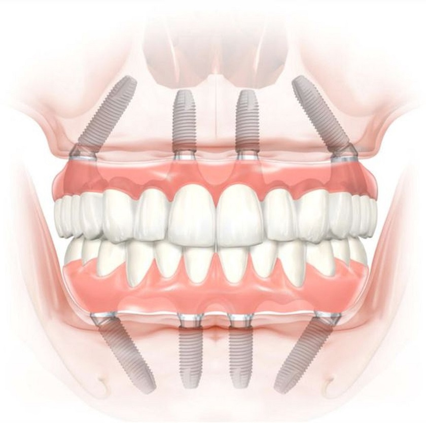 Răng Implant có độ bền cao
