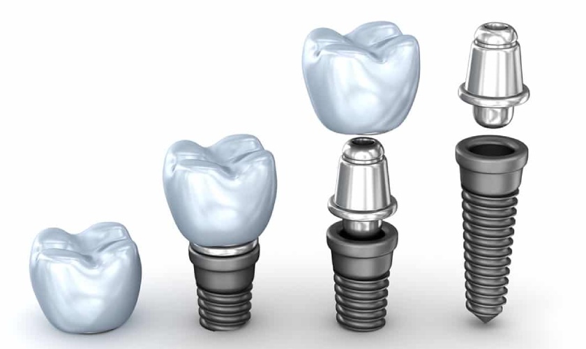 Nha khoa cắm implant uy tín phải sử dụng trụ implant và răng sứ chất lượng cao