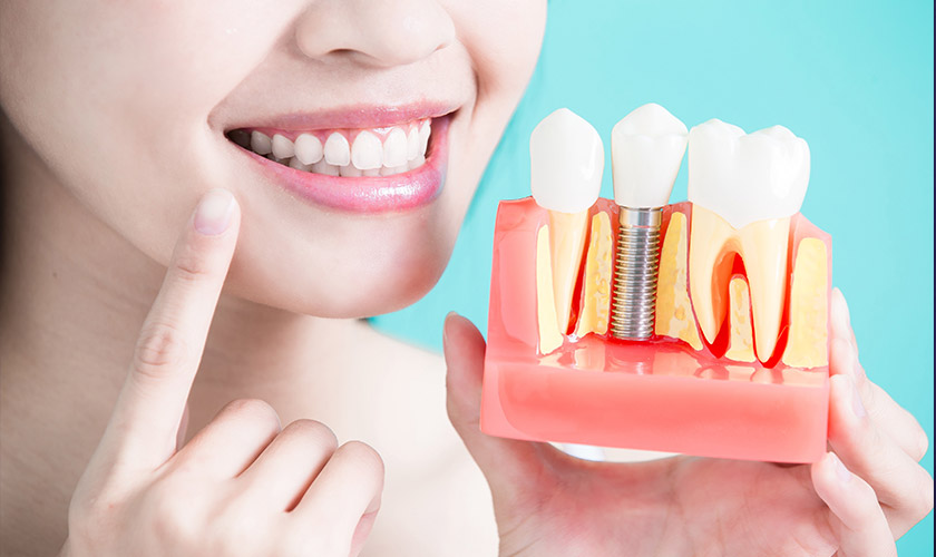 Răng implant mang lại thẩm mỹ cao