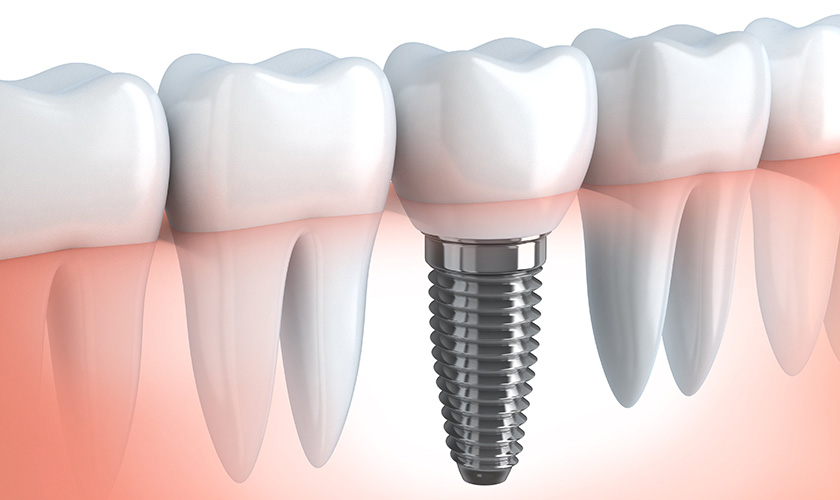 Implant được cấu thành từ titanium, cấy vào xương hàm đóng vai trò như một chân răng thật