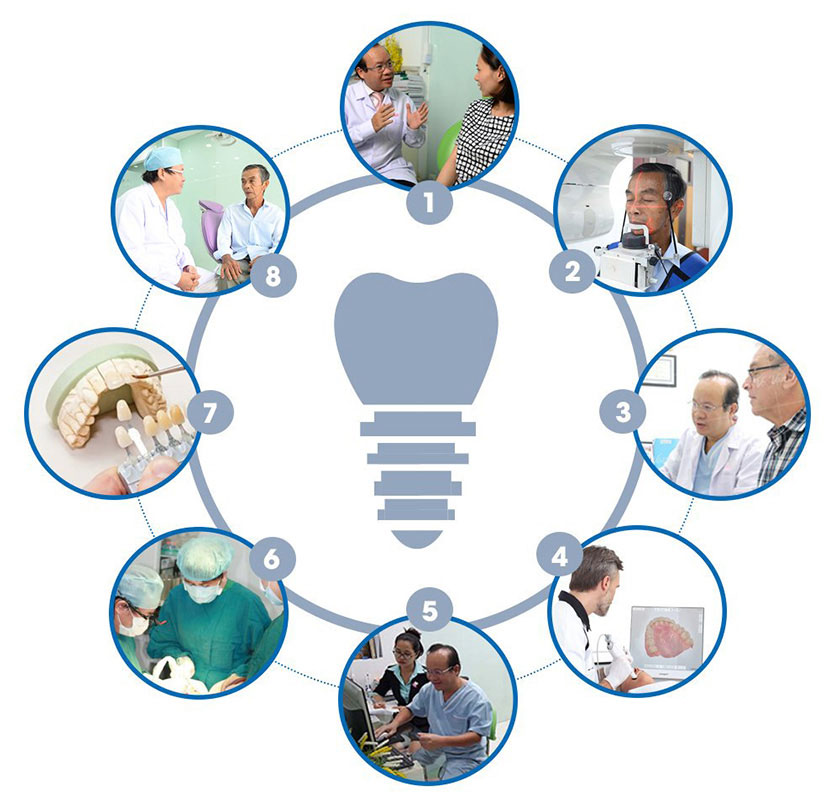 Quy trình cấy ghép implant Nha khoa Nhân Tâm