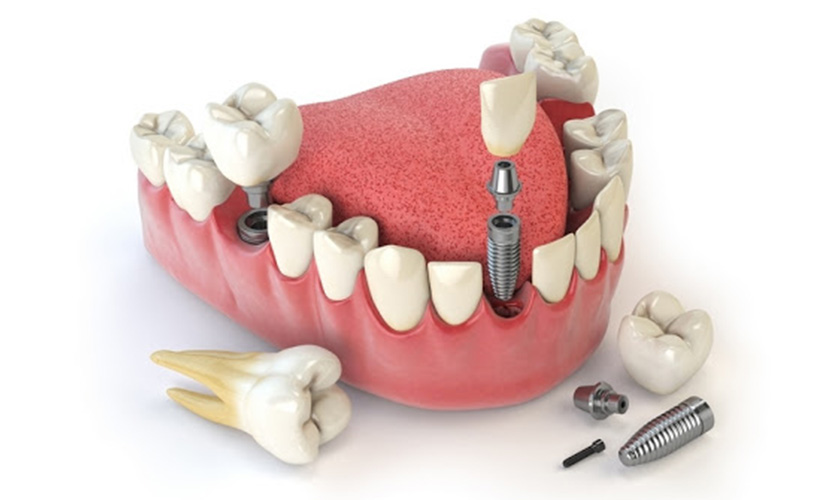 Cấy ghép răng implant là gì?