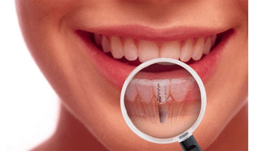 Thời gian tồn tại của răng implant phụ thuộc vào chất lượng trụ implant và răng sứ