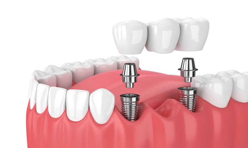 Phục hình nâng đỡ cấy ghép trên Implant