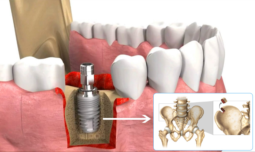 Trường hợp ghép xương sẽ tính thêm chi phí trồng răng implant