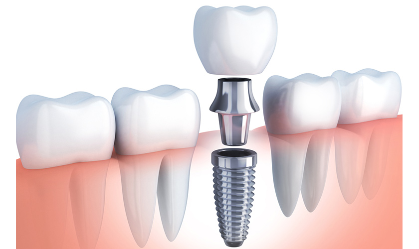 Cấy ghép implant là giải pháp phục hồi răng mất hiệu quả nhất hiện nay