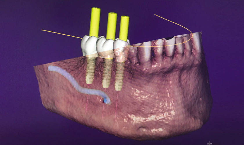 Lập kế hoạch điều trị implant