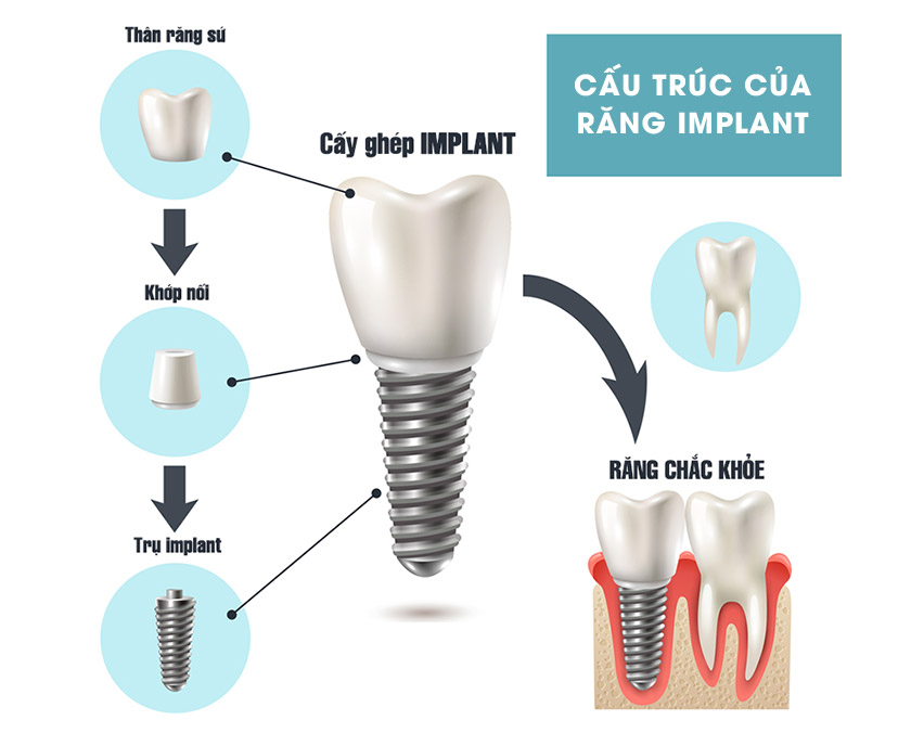 Cấu tạo của răng implant