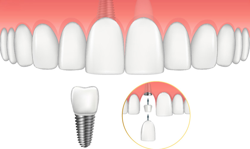 Cấy ghép răng implant hoàn toàn không tác động đến răng kế cận