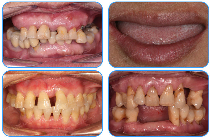 Những trường hợp có thể thực hiện cấy ghép răng implant