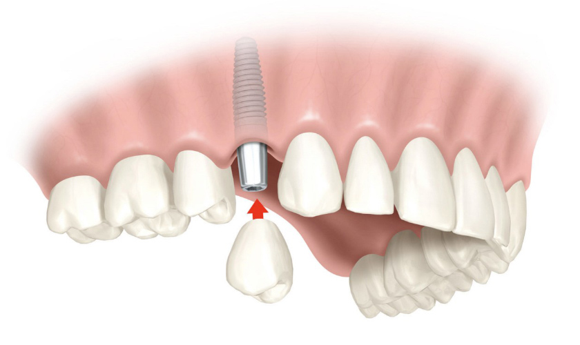 1 trụ implant trên 1 hàm