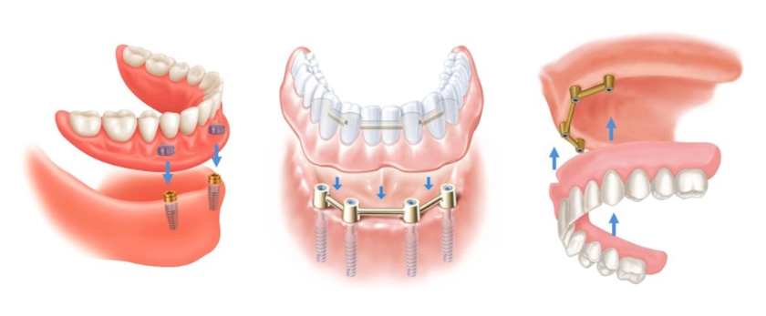 Răng giả tháo lắp trên implant
