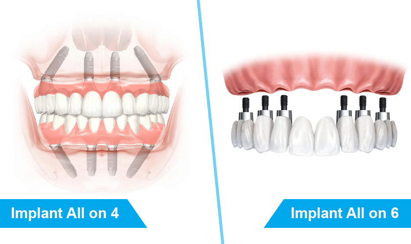 Implant All on 4 và Implant All on 6