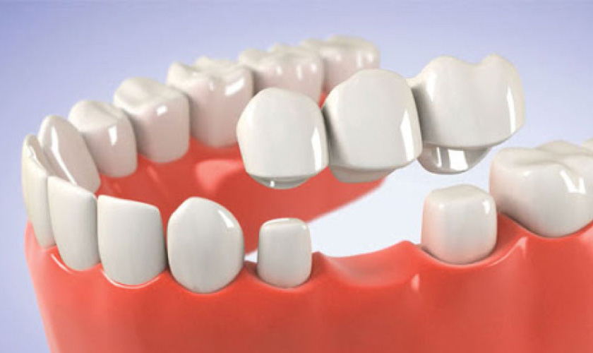 Phương pháp làm cầu răng sứ