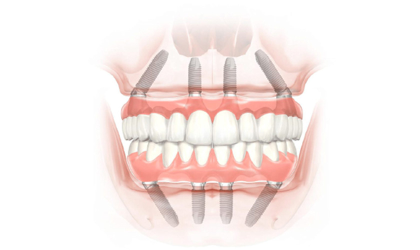 Cấy ghép Implant được áp dụng trong mọi trường hợp mất răng