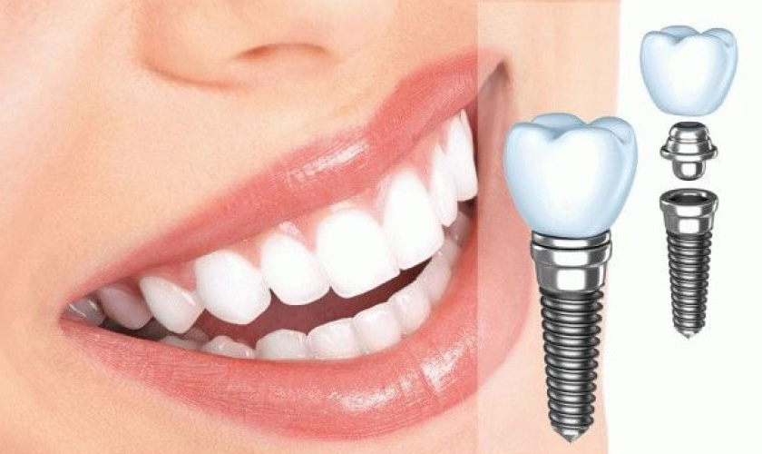 Răng tự nhiên hơn khi thực hiện cấy ghép Implant