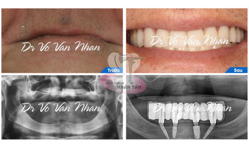 Hình ảnh chụp x-quang trước và sau khi trồng răng implant