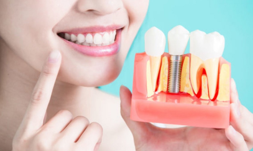 Răng implant có độ bền chắc lâu dài với thời gian