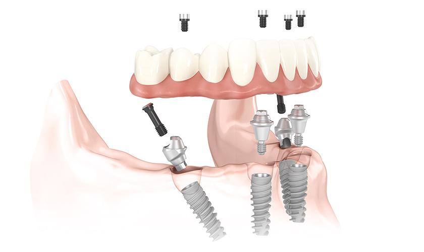 Trường hợp mất toàn bộ răng có thể cấy ghép implant all on X để tiết kiệm chi phí